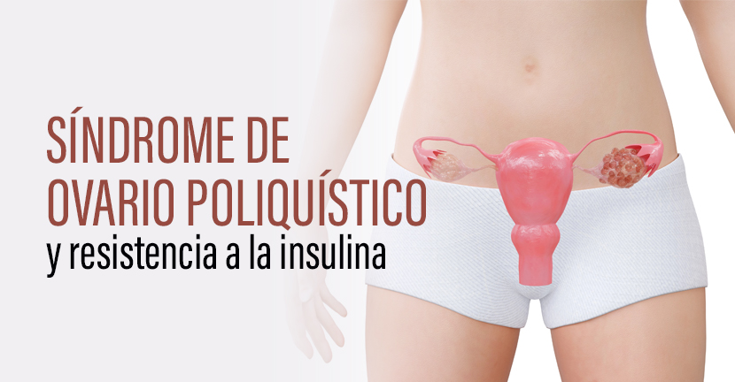 Síndrome de Ovario Poliquístico y Resistencia a la Insulina.